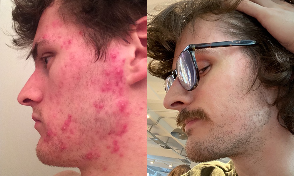 Side by side photos of Conor’s cheek: covered in acne, then clear
